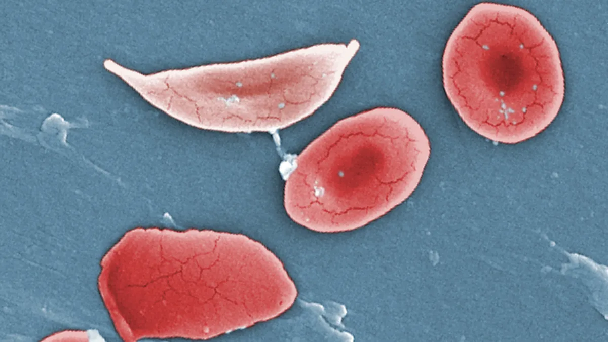 A sickle cell and normal blood cells are seen in red against a blue background in this colorized microscope image.