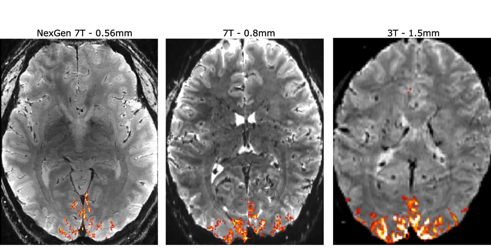 The human brain is seen at different MRI scan resolutions in this comparison image.