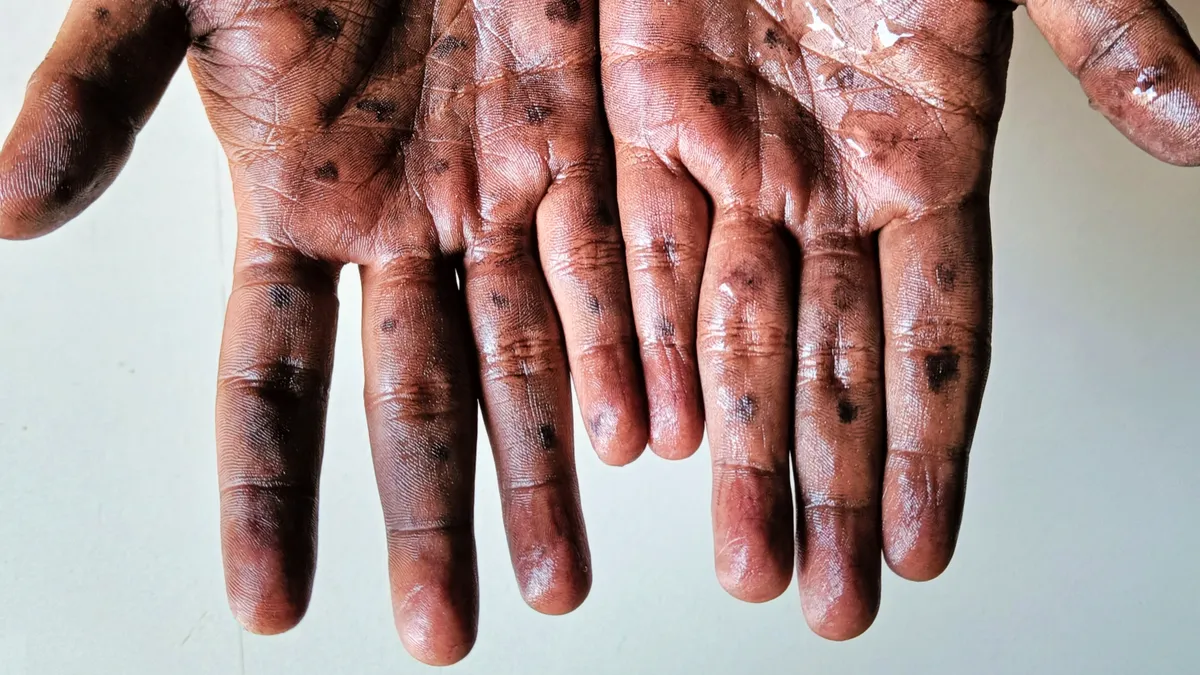 mpox hands