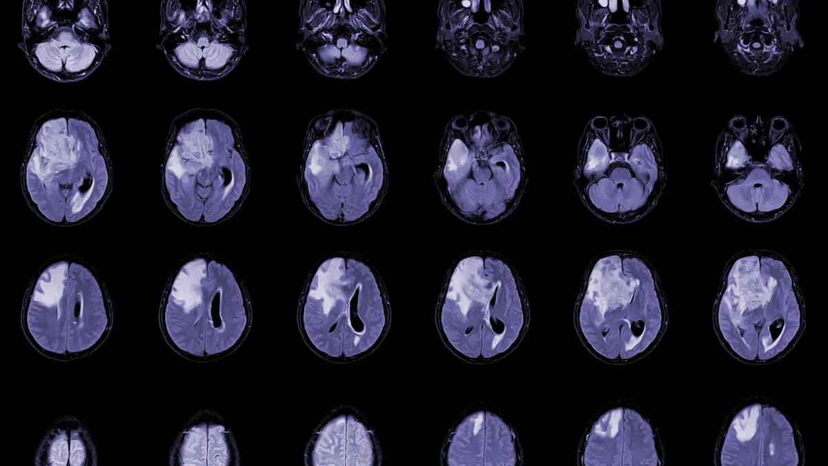 MRI Brain Axial Glioblastoma